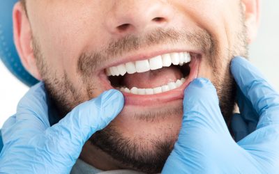 Considering Dental Fillings? 5 Reasons Why You Need One