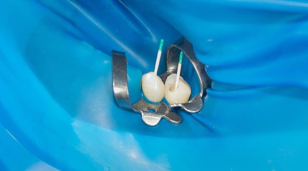 Photo Endodontic Treatment Of Dental Canals In The Lower Molar - Newmarket Dentists by Oasispark Dental