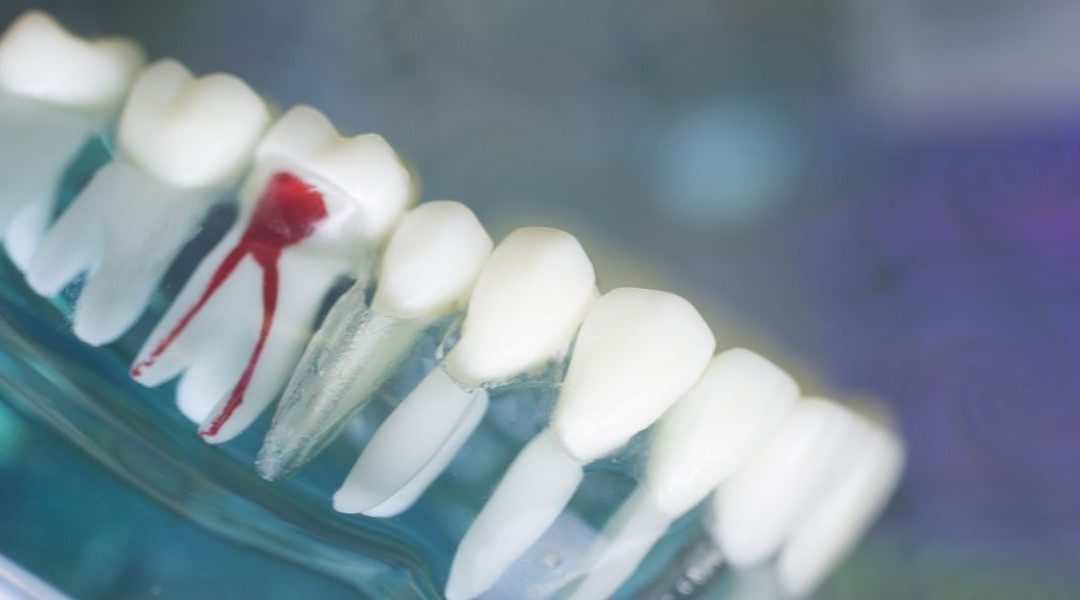 Newmarket Dentist: Is Endodontic Treatment Necessary?