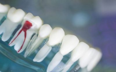 Newmarket Dentist: Is Endodontic Treatment Necessary?
