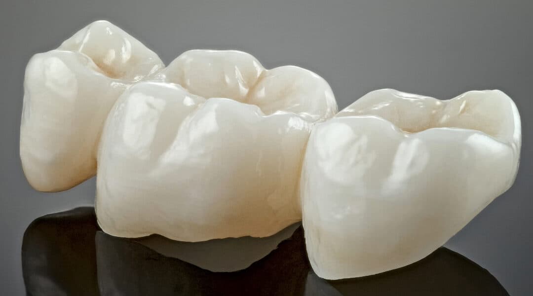 Dental crowns in Newmarket