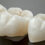 Broken To Beautiful: 8 Pros Of Dental Crowns | Newmarket
