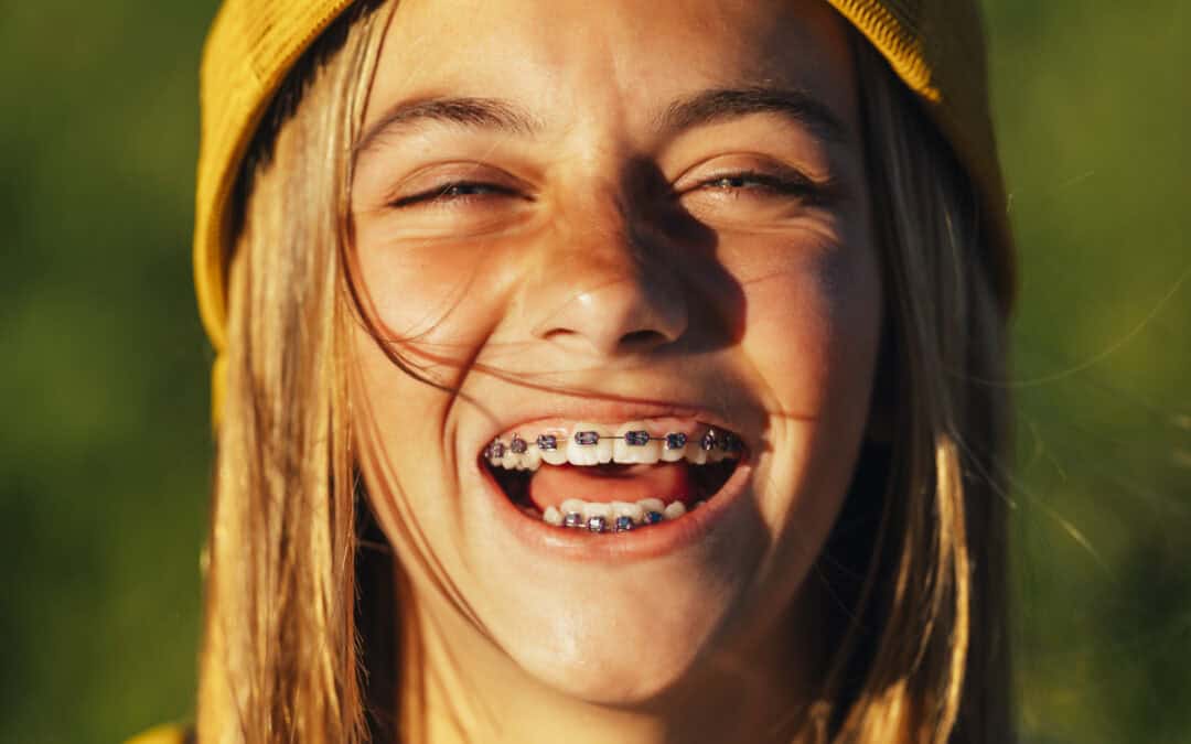 How Long Do Teeth Move with Braces?