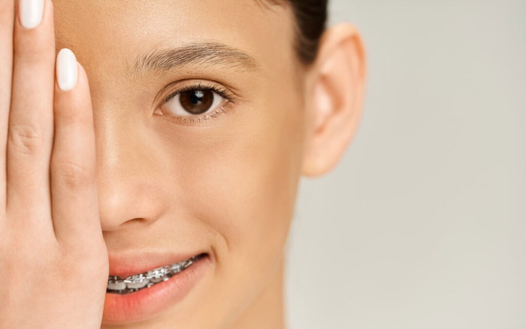 How Long Would Braces Take to Close a Gap? Guide To Recovery